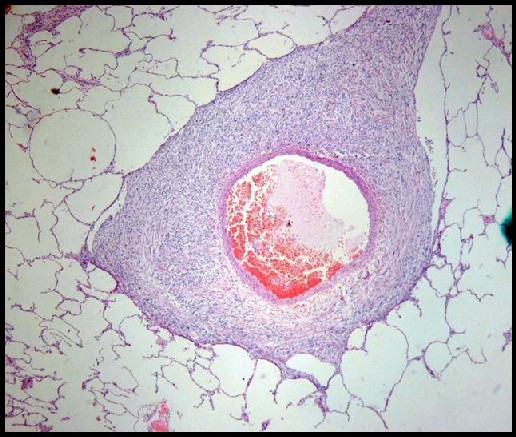 Fibromatosis tipo Desmoide - <div style=